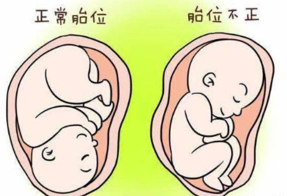 胎位不正